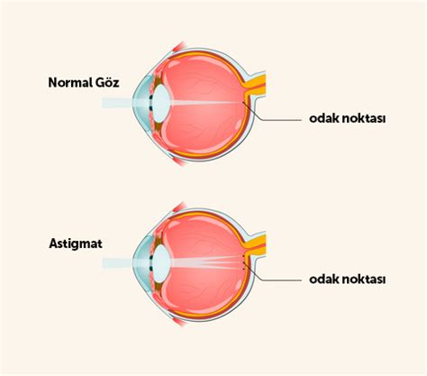 astigmat nedir belirtileri